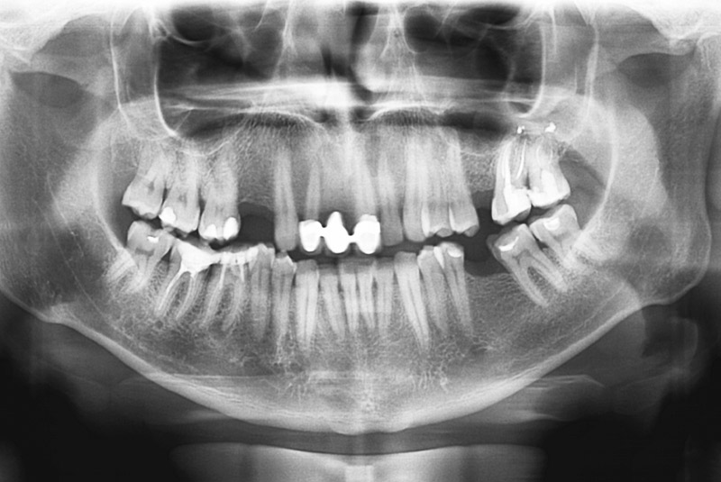 Missing teeth x-ray